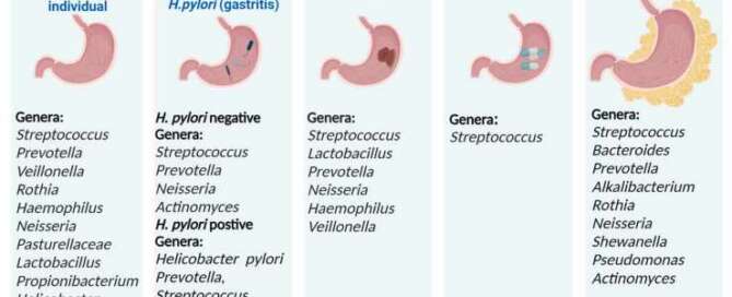 Microbioma gástrico y relación con cáncer gástrico